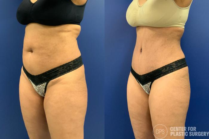 Liposuction Case 196 Before & After Left Oblique | Chevy Chase & Annandale, Washington D.C. Metropolitan Area | Center for Plastic Surgery