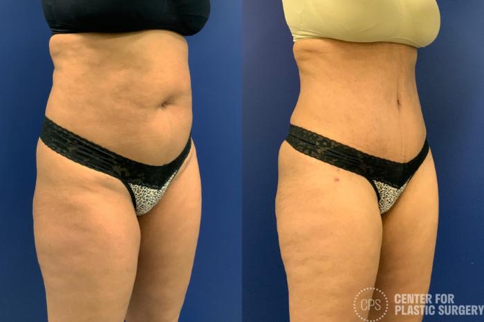 Liposuction Case 196 Before & After Right Oblique | Chevy Chase & Annandale, Washington D.C. Metropolitan Area | Center for Plastic Surgery