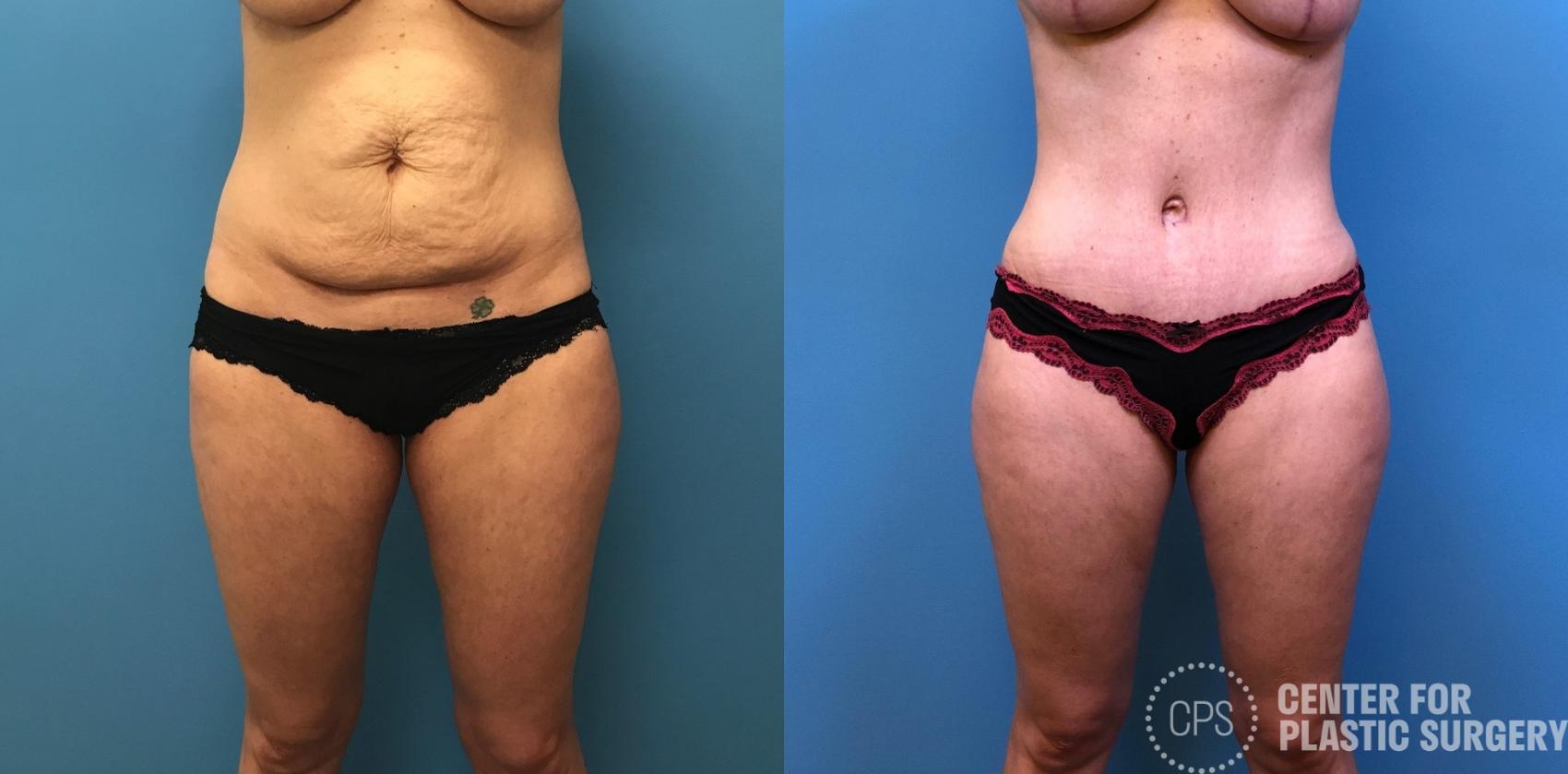 Liposuction Case 244 Before & After Front | Annandale, Washington D.C. Metropolitan Area | Center for Plastic Surgery