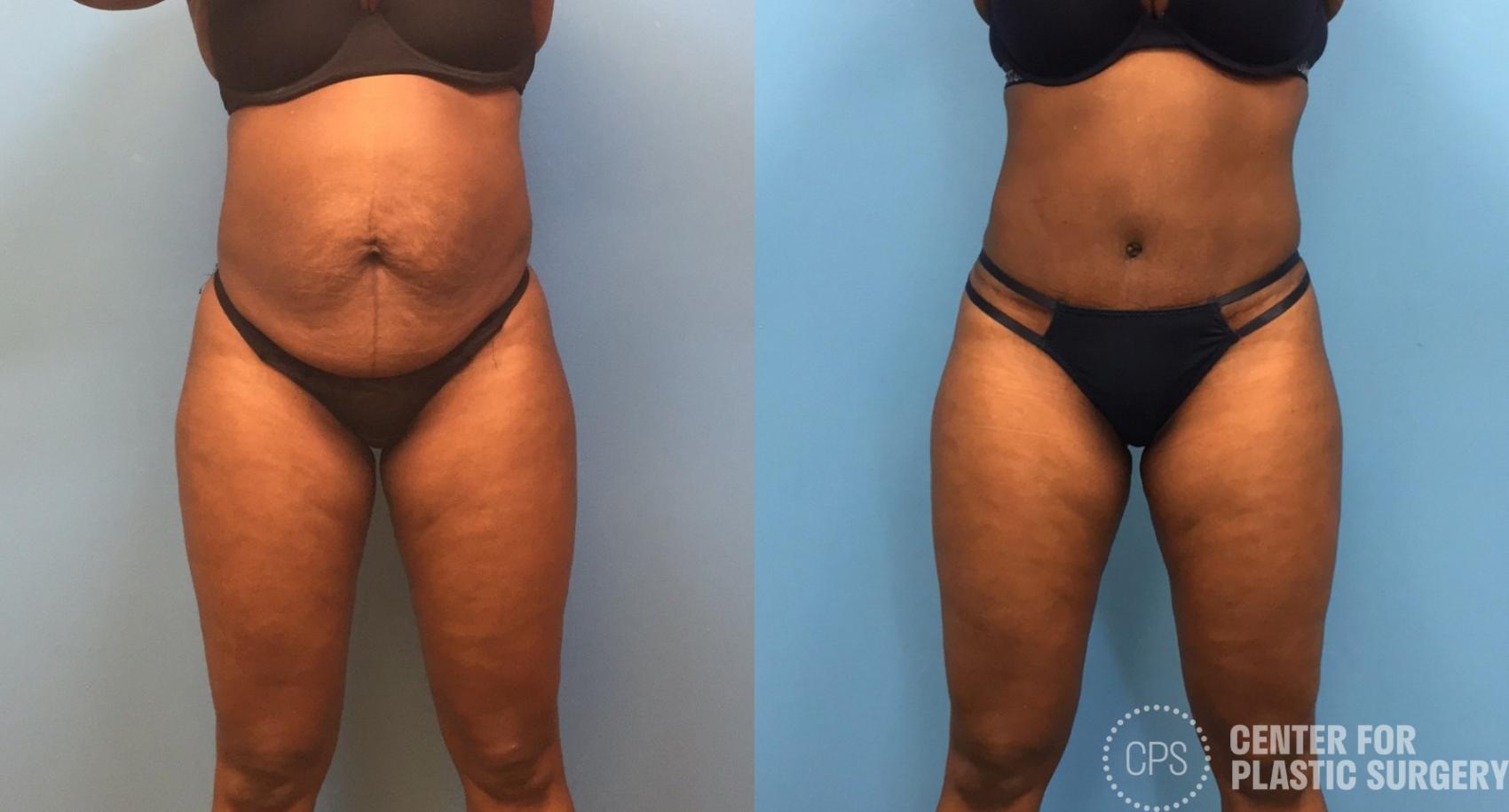 Liposuction Case 246 Before & After Front | Chevy Chase & Annandale, Washington D.C. Metropolitan Area | Center for Plastic Surgery