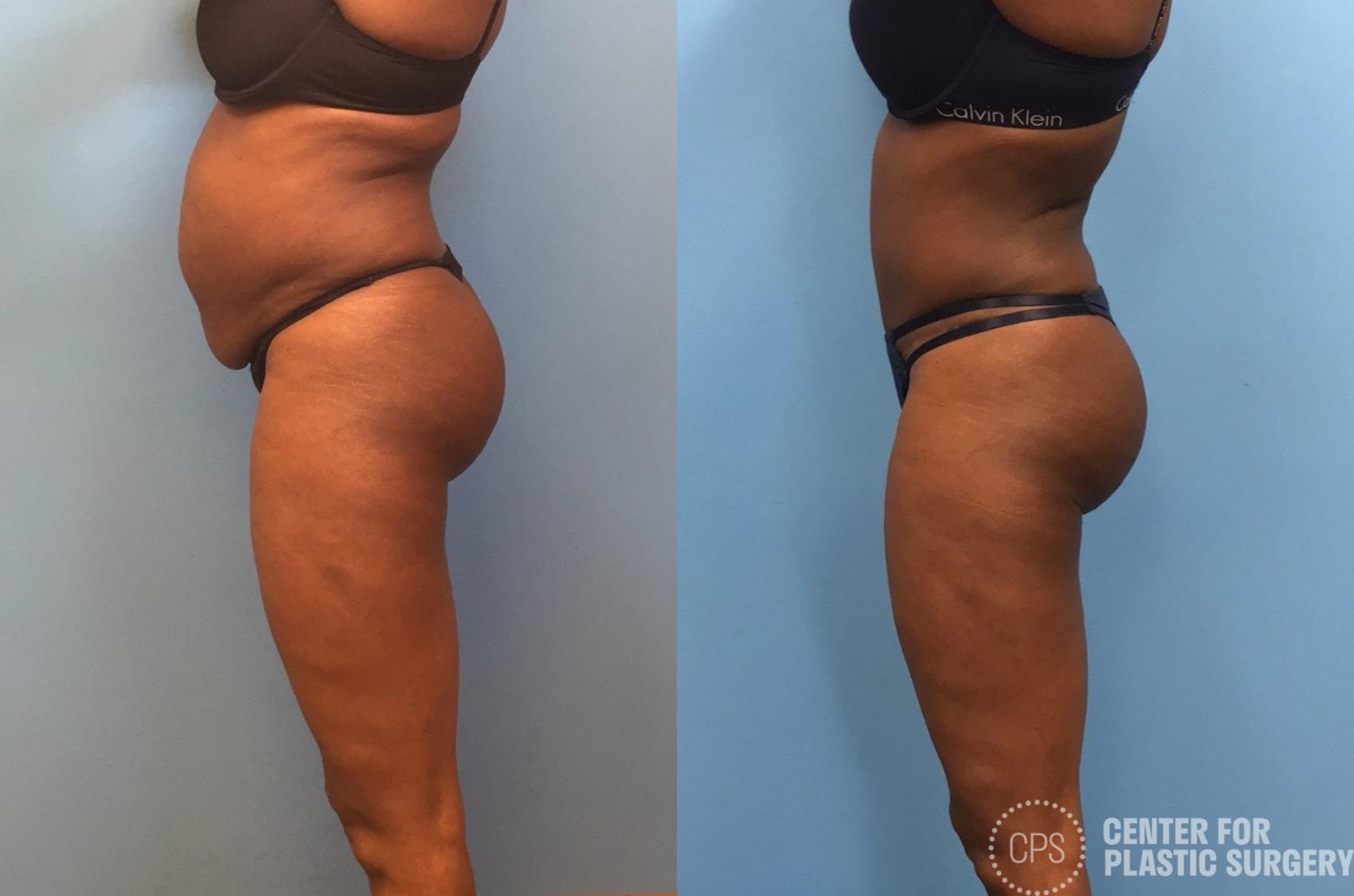 Liposuction Case 246 Before & After Left Side | Chevy Chase & Annandale, Washington D.C. Metropolitan Area | Center for Plastic Surgery