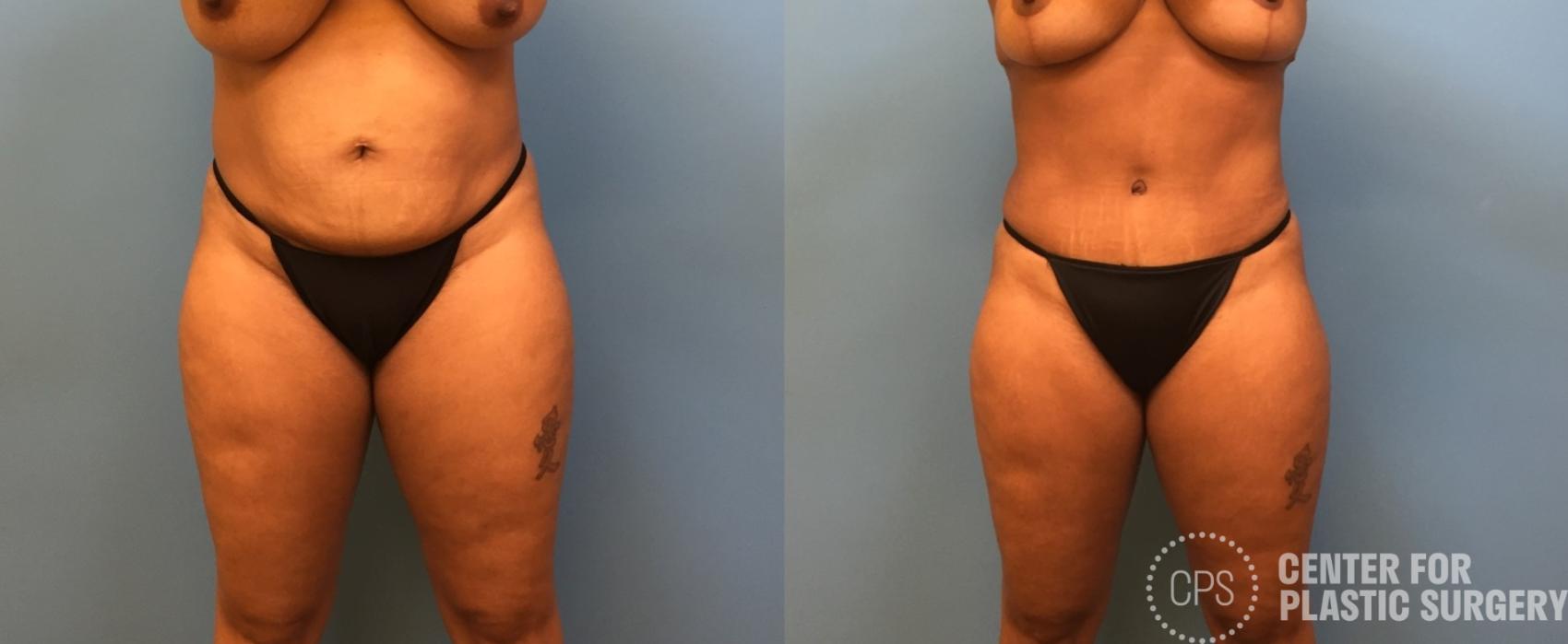 Liposuction Case 247 Before & After Front | Annandale, Washington D.C. Metropolitan Area | Center for Plastic Surgery