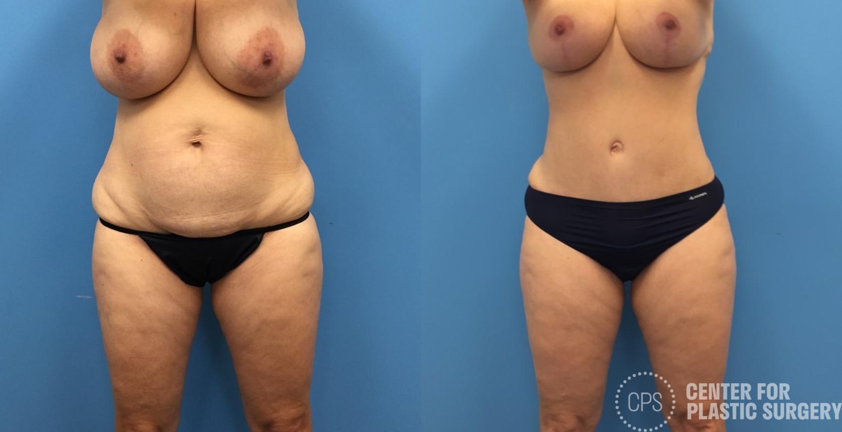 Liposuction Case 248 Before & After Front | Chevy Chase & Annandale, Washington D.C. Metropolitan Area | Center for Plastic Surgery