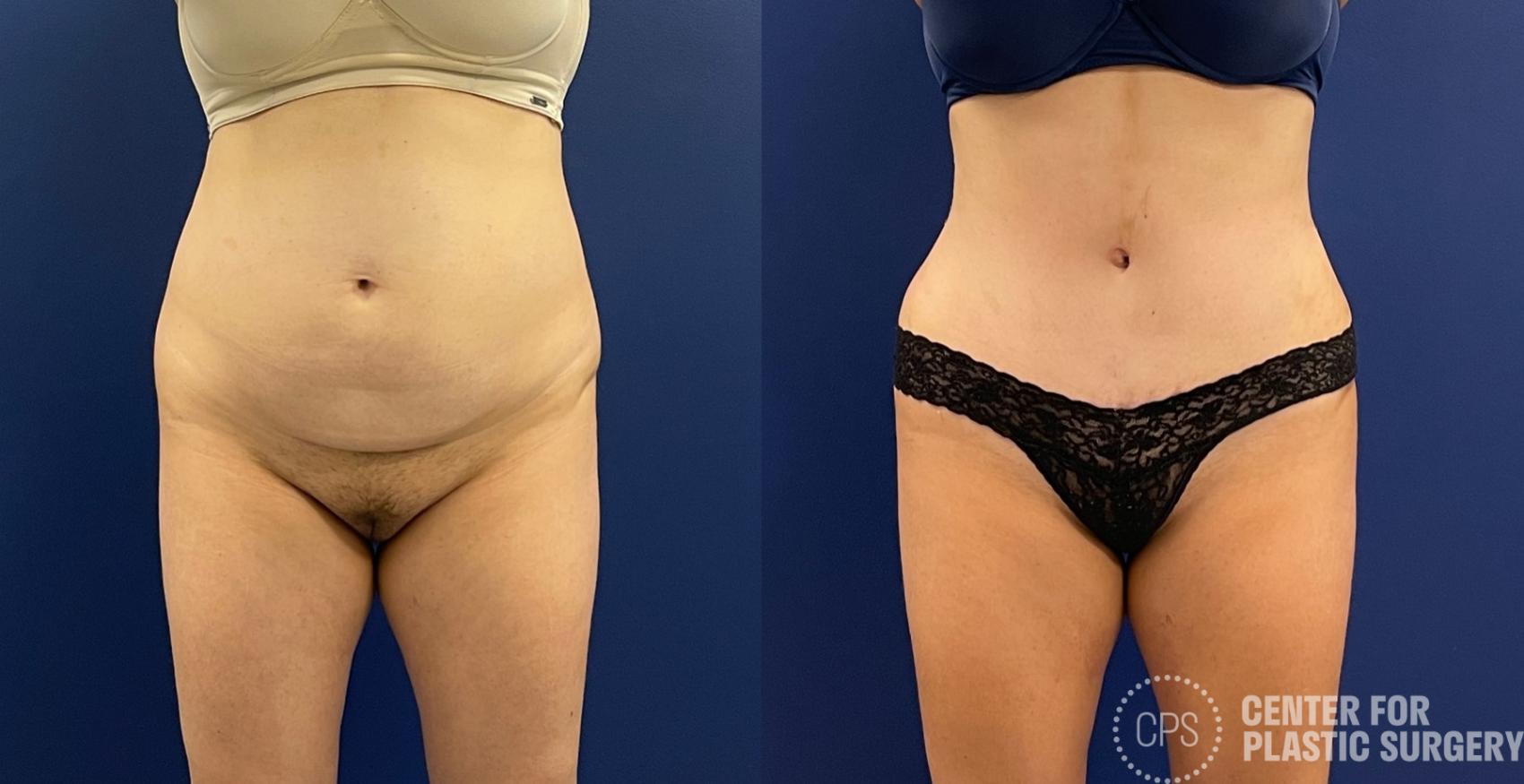 Liposuction Case 256 Before & After Front | Chevy Chase & Annandale, Washington D.C. Metropolitan Area | Center for Plastic Surgery