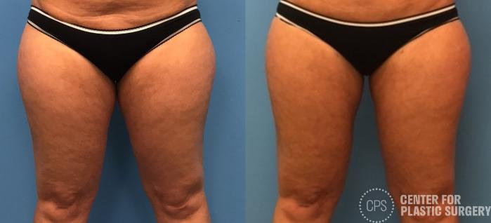 Liposuction Case 278 Before & After Front | Chevy Chase & Annandale, Washington D.C. Metropolitan Area | Center for Plastic Surgery