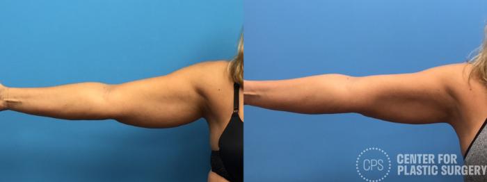 Liposuction Case 280 Before & After Front Left | Chevy Chase & Annandale, Washington D.C. Metropolitan Area | Center for Plastic Surgery
