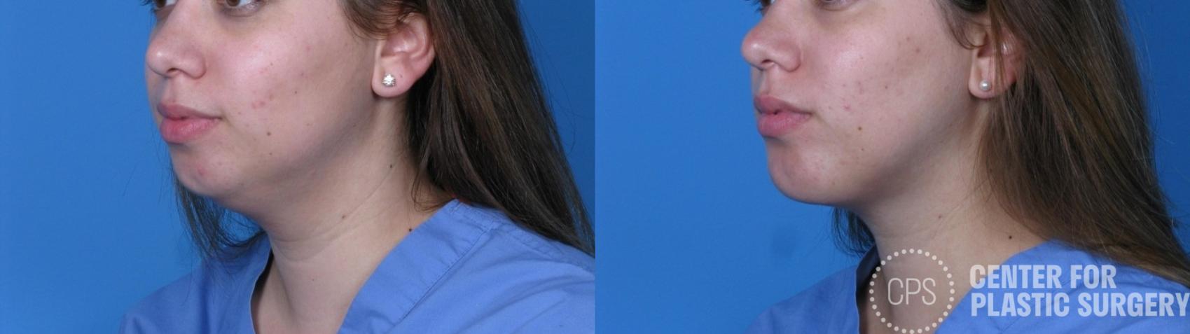 Liposuction Case 293 Before & After Left Oblique | Chevy Chase & Annandale, Washington D.C. Metropolitan Area | Center for Plastic Surgery