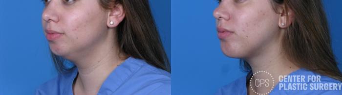 Liposuction Case 293 Before & After Left Oblique | Chevy Chase & Annandale, Washington D.C. Metropolitan Area | Center for Plastic Surgery