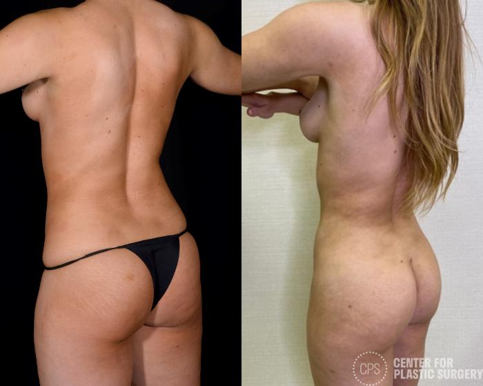 Brazilian Butt Lift Case 366 Before & After Back Left | Chevy Chase & Annandale, Washington D.C. Metropolitan Area | Center for Plastic Surgery