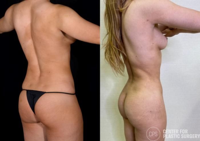 Brazilian Butt Lift Case 366 Before & After Back Right | Chevy Chase & Annandale, Washington D.C. Metropolitan Area | Center for Plastic Surgery