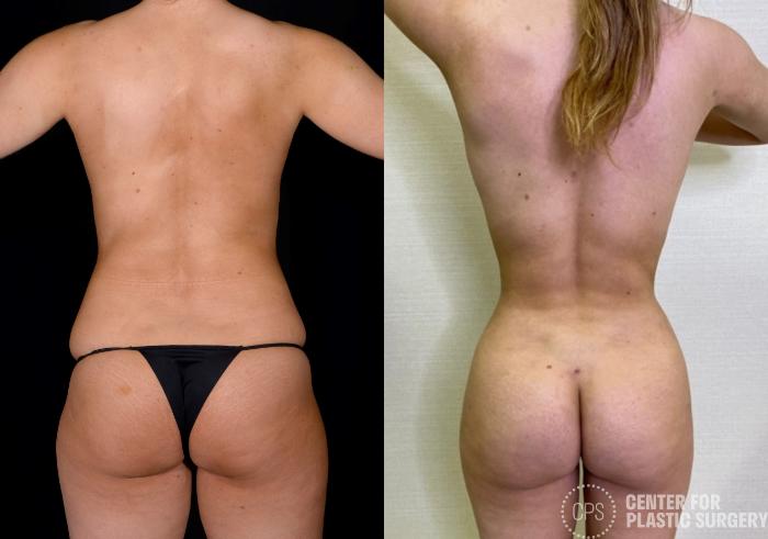 Liposuction Case 366 Before & After Back | Chevy Chase & Annandale, Washington D.C. Metropolitan Area | Center for Plastic Surgery