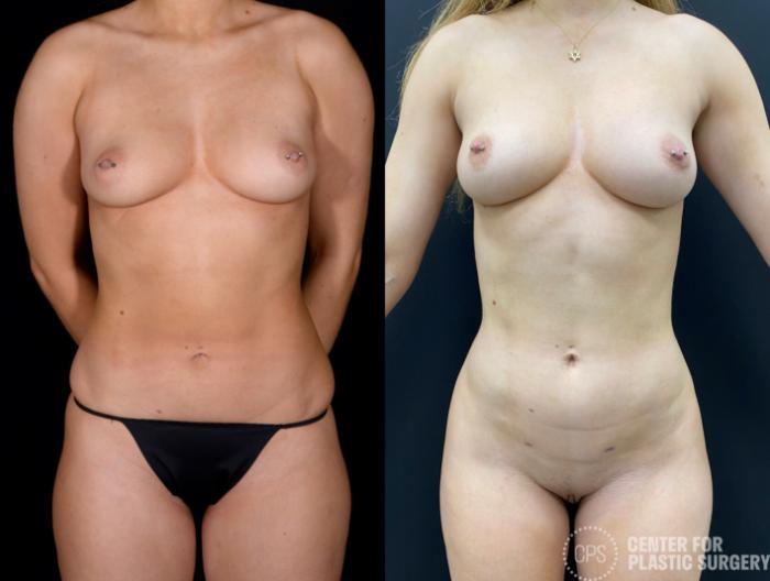 Liposuction Case 366 Before & After Front | Chevy Chase & Annandale, Washington D.C. Metropolitan Area | Center for Plastic Surgery