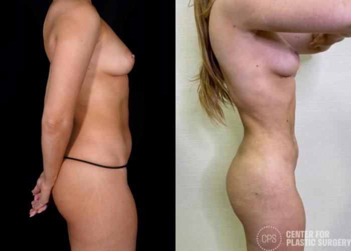 Brazilian Butt Lift Case 366 Before & After Right Side | Chevy Chase & Annandale, Washington D.C. Metropolitan Area | Center for Plastic Surgery