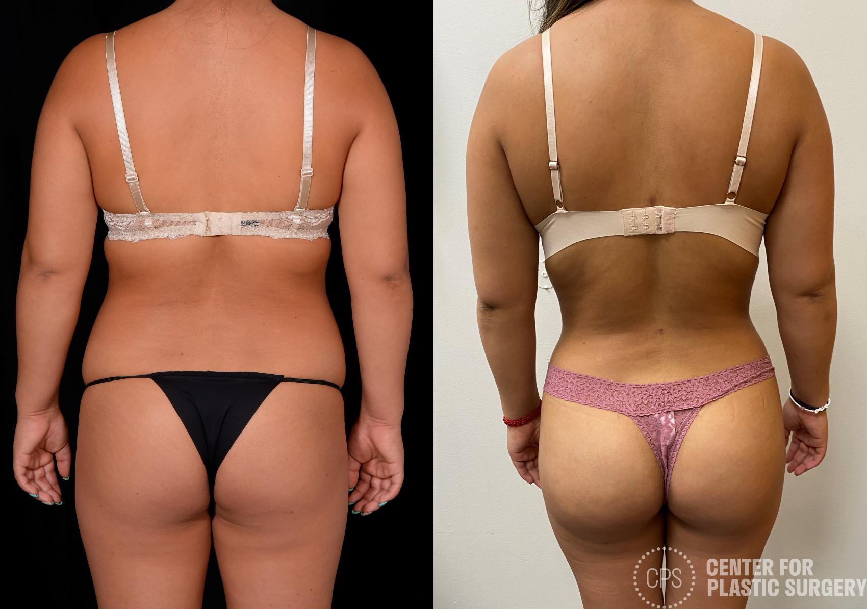 Liposuction Case 367 Before & After Back | Annandale, Washington D.C. Metropolitan Area | Center for Plastic Surgery