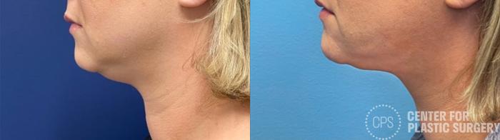 Liposuction Case 388 Before & After Left Side | Chevy Chase & Annandale, Washington D.C. Metropolitan Area | Center for Plastic Surgery