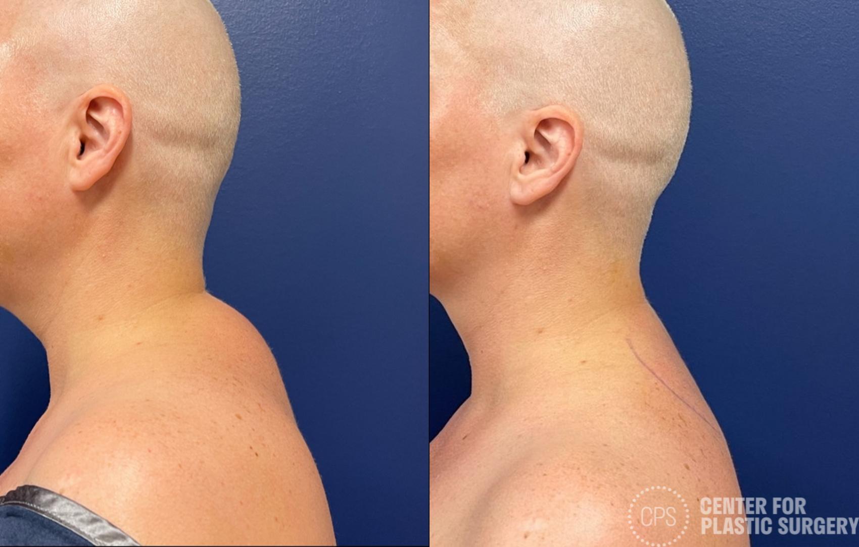 Liposuction Case 396 Before & After Left Side | Chevy Chase & Annandale, Washington D.C. Metropolitan Area | Center for Plastic Surgery