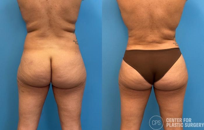 Brazilian Butt Lift Case 427 Before & After Back | Chevy Chase & Annandale, Washington D.C. Metropolitan Area | Center for Plastic Surgery