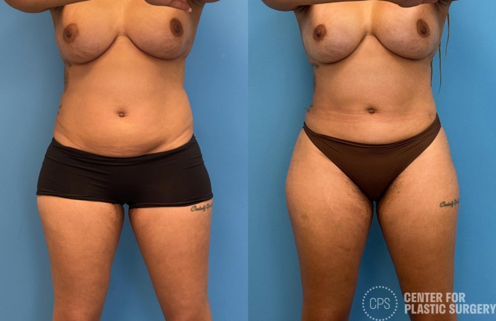 Liposuction Case 427 Before & After Front | Chevy Chase & Annandale, Washington D.C. Metropolitan Area | Center for Plastic Surgery