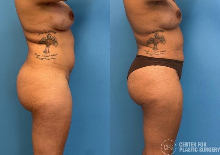 Brazilian Butt Lift Case 427 Before & After Right Side | Chevy Chase & Annandale, Washington D.C. Metropolitan Area | Center for Plastic Surgery