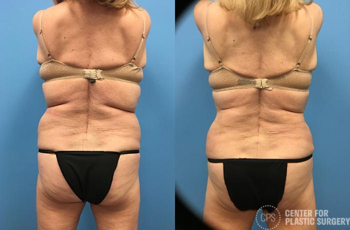 Tummy Tuck Case 59 Before & After Back | Chevy Chase & Annandale, Washington D.C. Metropolitan Area | Center for Plastic Surgery