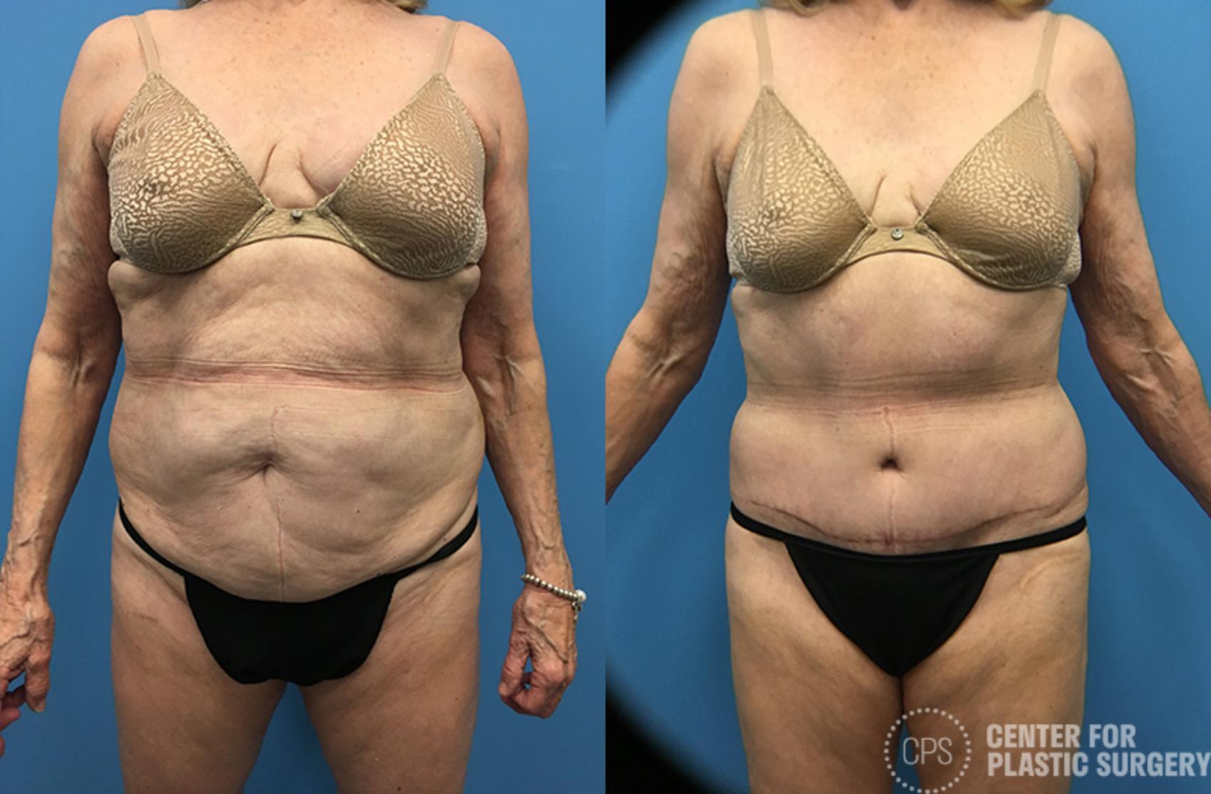 Liposuction Case 59 Before & After Front | Chevy Chase & Annandale, Washington D.C. Metropolitan Area | Center for Plastic Surgery