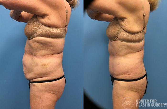 Liposuction Case 59 Before & After Left Side | Chevy Chase & Annandale, Washington D.C. Metropolitan Area | Center for Plastic Surgery