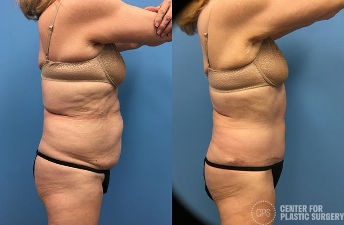 Tummy Tuck Case 59 Before & After Right Side | Chevy Chase & Annandale, Washington D.C. Metropolitan Area | Center for Plastic Surgery