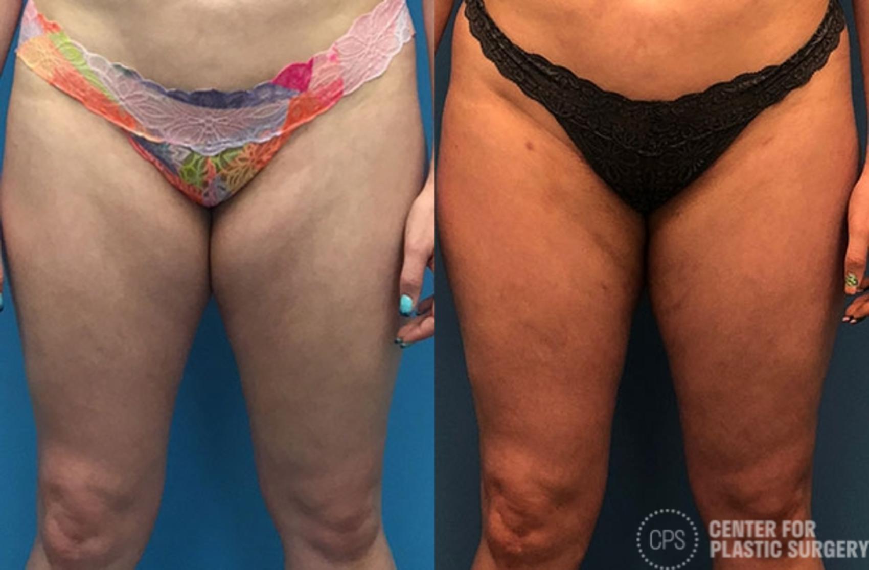 Liposuction Case 66 Before & After Front | Annandale, Washington D.C. Metropolitan Area | Center for Plastic Surgery