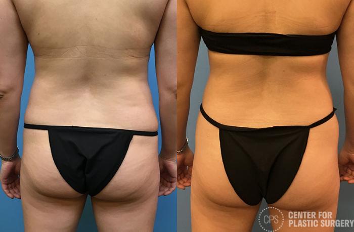 Liposuction Case 67 Before & After Back | Chevy Chase & Annandale, Washington D.C. Metropolitan Area | Center for Plastic Surgery