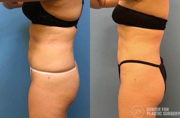 Liposuction Case 67 Before & After Left Side | Chevy Chase & Annandale, Washington D.C. Metropolitan Area | Center for Plastic Surgery