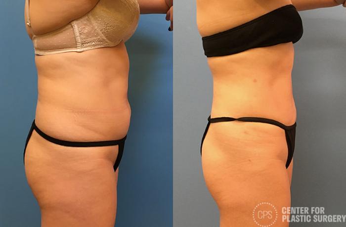 Liposuction Case 67 Before & After Right Side | Chevy Chase & Annandale, Washington D.C. Metropolitan Area | Center for Plastic Surgery