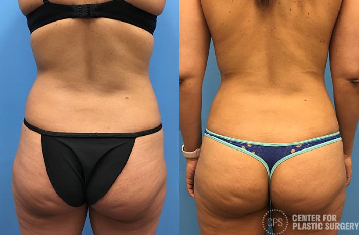 Liposuction Case 68 Before & After Back | Chevy Chase & Annandale, Washington D.C. Metropolitan Area | Center for Plastic Surgery