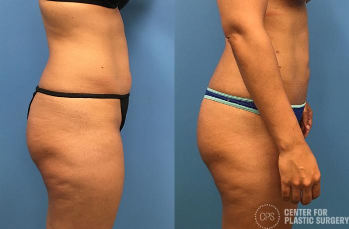 Liposuction Case 68 Before & After Right Side | Chevy Chase & Annandale, Washington D.C. Metropolitan Area | Center for Plastic Surgery