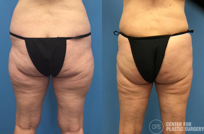 Liposuction Case 69 Before & After Back | Chevy Chase & Annandale, Washington D.C. Metropolitan Area | Center for Plastic Surgery