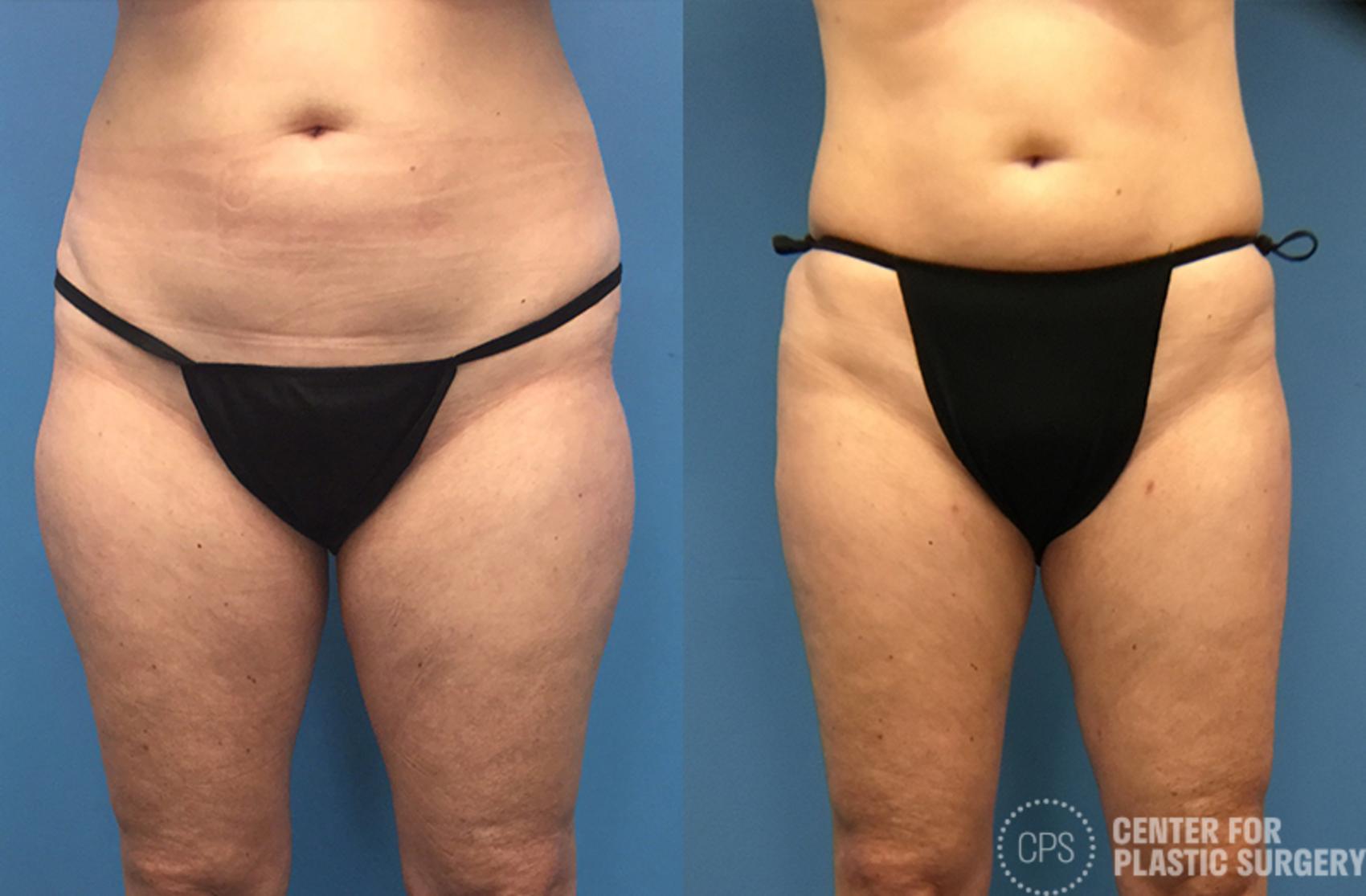 Liposuction Case 69 Before & After Front | Chevy Chase & Annandale, Washington D.C. Metropolitan Area | Center for Plastic Surgery