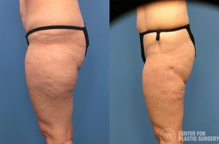 Liposuction Case 69 Before & After Left Side | Chevy Chase & Annandale, Washington D.C. Metropolitan Area | Center for Plastic Surgery
