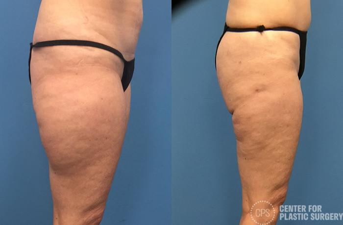 Liposuction Case 69 Before & After Right Side | Chevy Chase & Annandale, Washington D.C. Metropolitan Area | Center for Plastic Surgery