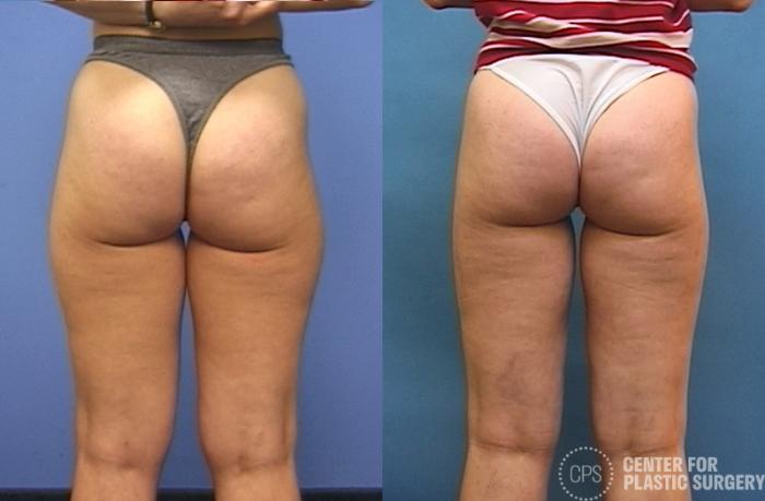 Liposuction Case 70 Before & After Back | Chevy Chase & Annandale, Washington D.C. Metropolitan Area | Center for Plastic Surgery