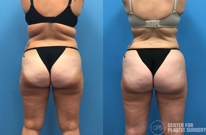 Liposuction Case 71 Before & After Back | Chevy Chase & Annandale, Washington D.C. Metropolitan Area | Center for Plastic Surgery