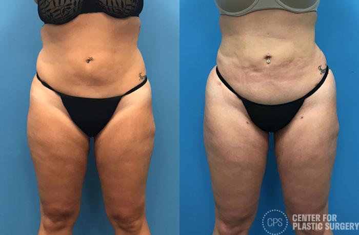 Liposuction Case 71 Before & After Front | Chevy Chase & Annandale, Washington D.C. Metropolitan Area | Center for Plastic Surgery