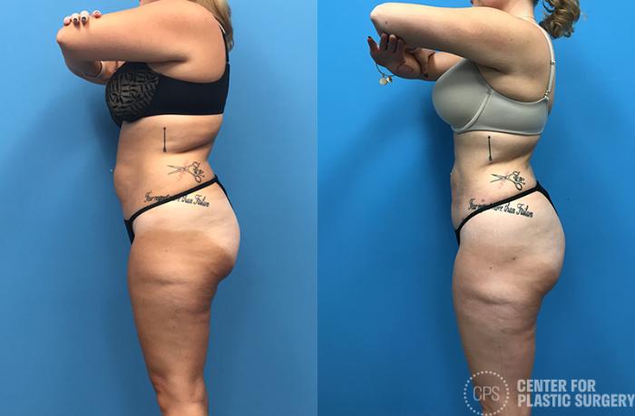 Liposuction Case 71 Before & After Left Side | Chevy Chase & Annandale, Washington D.C. Metropolitan Area | Center for Plastic Surgery