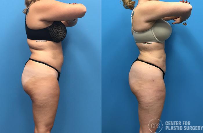 Liposuction Case 71 Before & After Right Side | Chevy Chase & Annandale, Washington D.C. Metropolitan Area | Center for Plastic Surgery