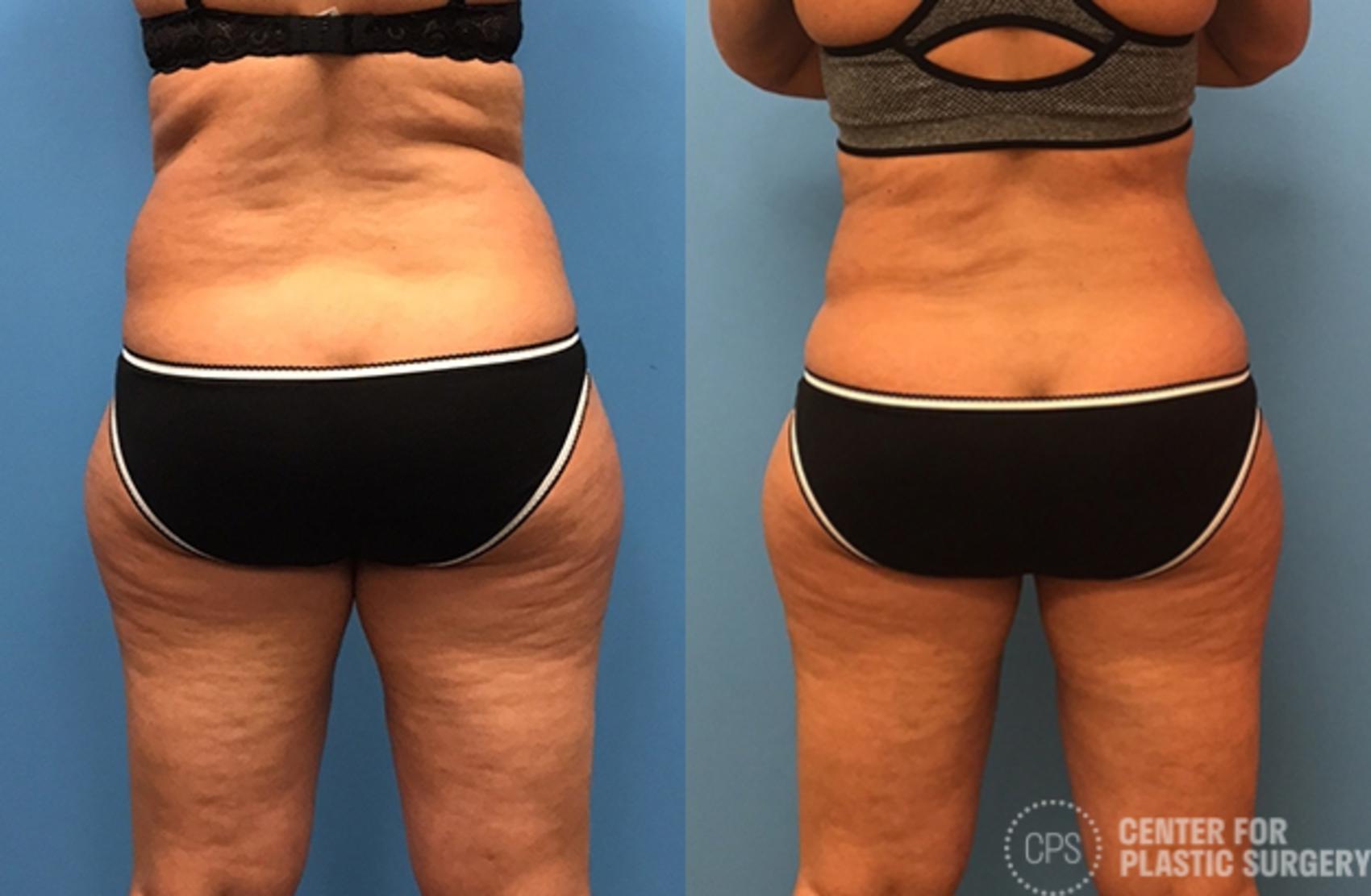 Liposuction Case 72 Before & After Back | Chevy Chase & Annandale, Washington D.C. Metropolitan Area | Center for Plastic Surgery