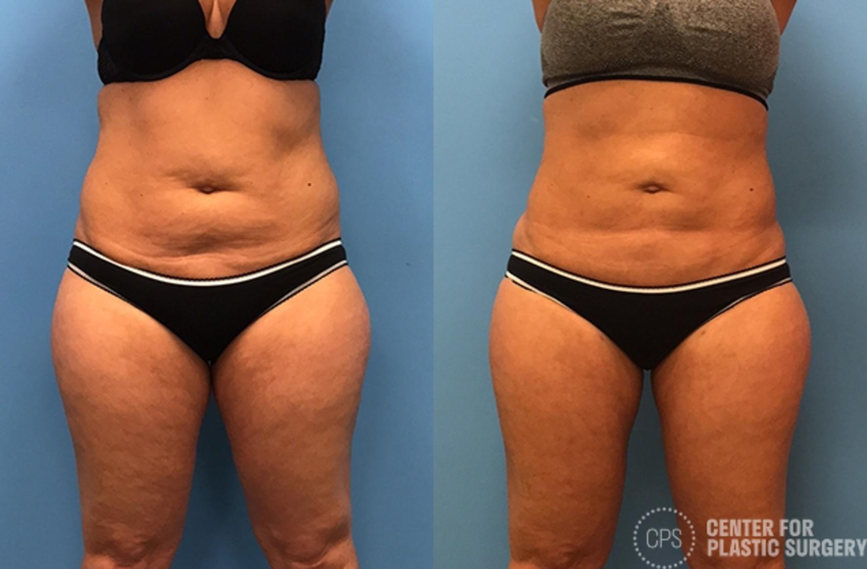 Liposuction Case 72 Before & After Front | Chevy Chase & Annandale, Washington D.C. Metropolitan Area | Center for Plastic Surgery