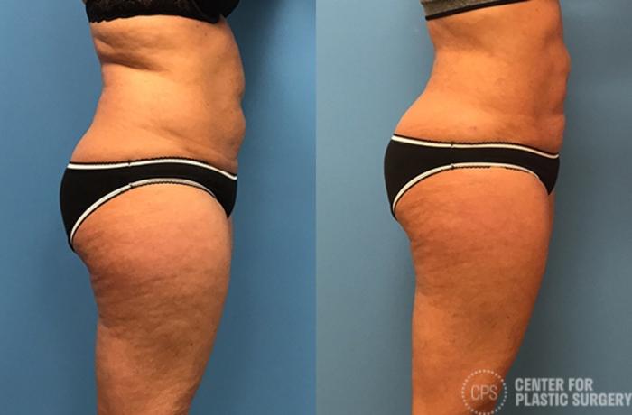 Liposuction Case 72 Before & After Right Side | Chevy Chase & Annandale, Washington D.C. Metropolitan Area | Center for Plastic Surgery