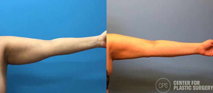 Liposuction Case 78 Before & After Left Arm, Front | Chevy Chase & Annandale, Washington D.C. Metropolitan Area | Center for Plastic Surgery