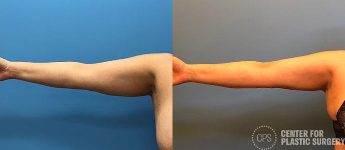 Liposuction Case 78 Before & After Right Arm, Front | Chevy Chase & Annandale, Washington D.C. Metropolitan Area | Center for Plastic Surgery