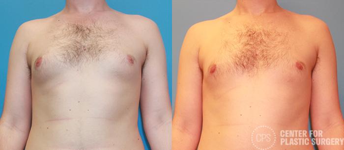 Male Breast Reduction / Gynecomastia Case 141 Before & After Front | Chevy Chase & Annandale, Washington D.C. Metropolitan Area | Center for Plastic Surgery