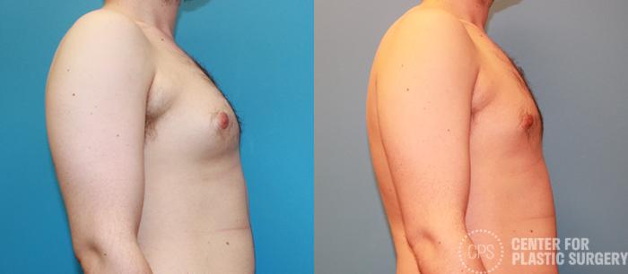 Male Breast Reduction / Gynecomastia Case 141 Before & After Right Side | Chevy Chase & Annandale, Washington D.C. Metropolitan Area | Center for Plastic Surgery