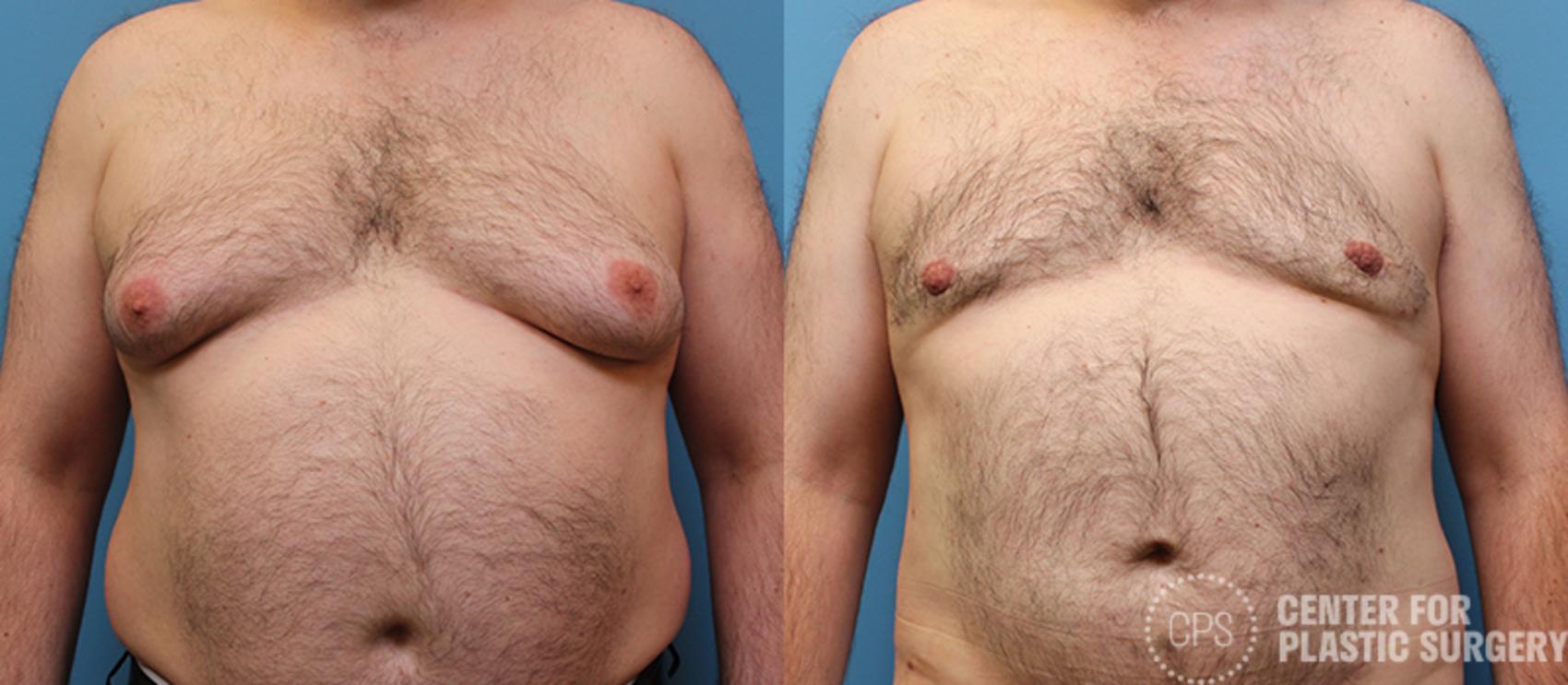 Male Breast Reduction / Gynecomastia Case 142 Before & After Front | Chevy Chase & Annandale, Washington D.C. Metropolitan Area | Center for Plastic Surgery